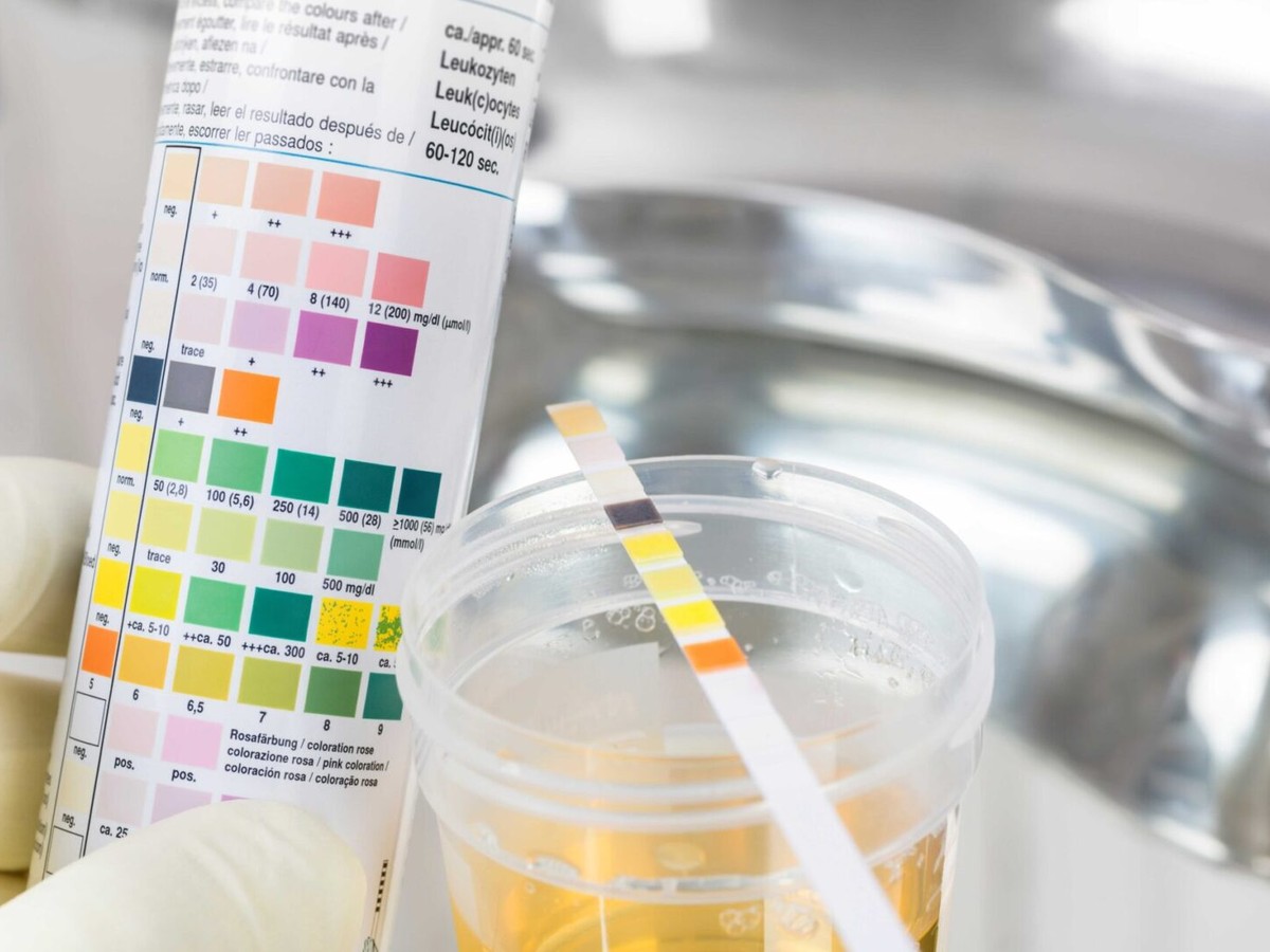 Urine Analysis